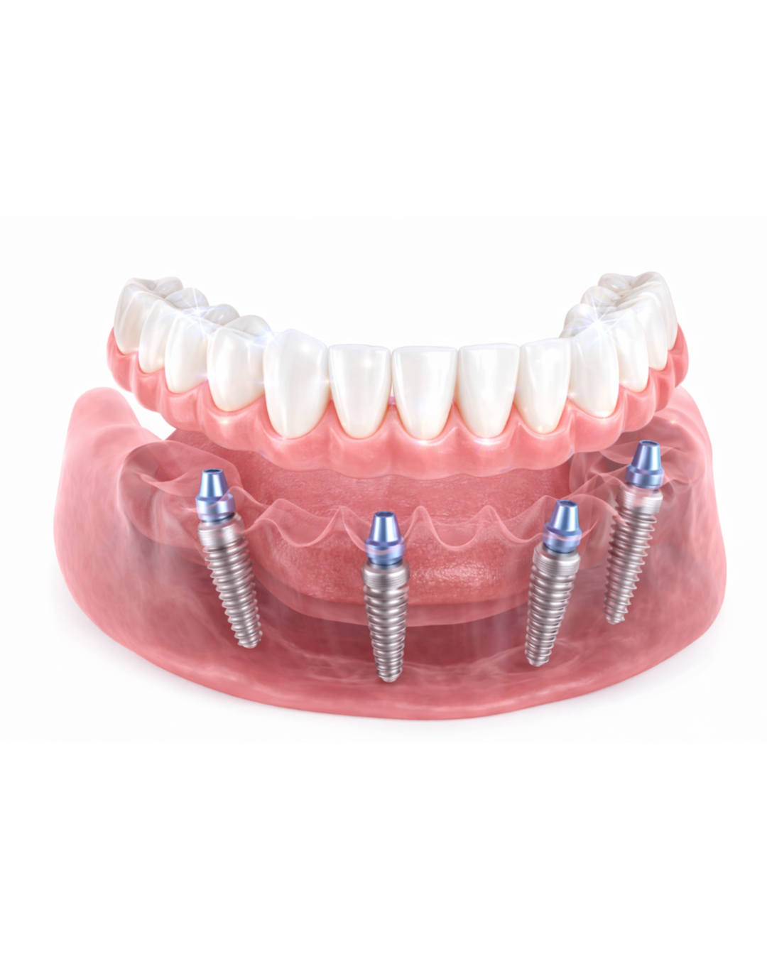 Zirconia Full Arch